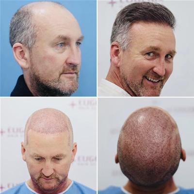 Is Beard Hair Viable For A Hair Transplant