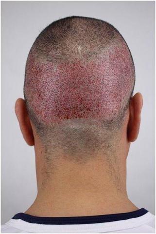 FUE Hair Transplant: Manual Versus Motorized Extraction Devices