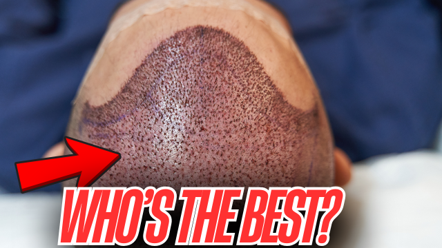 How to Find the Best Hair Transplant Surgeon in California