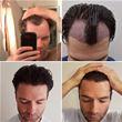 Scott UK Patient Advisor Hair Transplant Journey