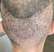 Hair Transplant Surgery Donor Depletion or Shock Loss?