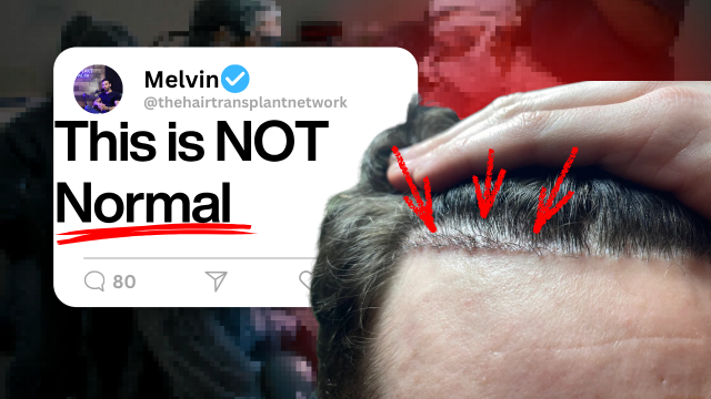 The Epidemic of Botched Hair Transplants- How To Find A Good Surgeon