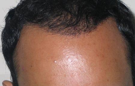 Topical Hair Loss Cover Ups