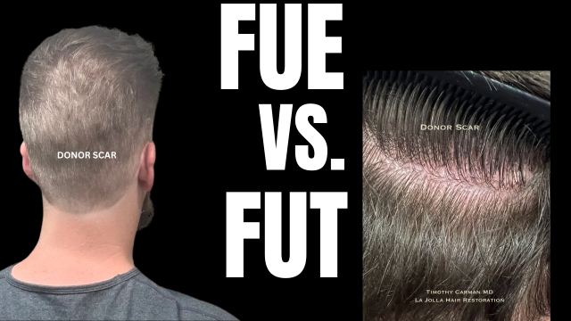 FUE vs FUT Hair Transplant: Which Is Better for You?