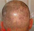 How To Deal with Donor Shock Loss After a Hair Transplant