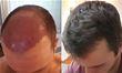 3 Ways To Conceal A Hair Transplant