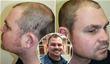 What Is The Best Age To Get A Hair Transplant?