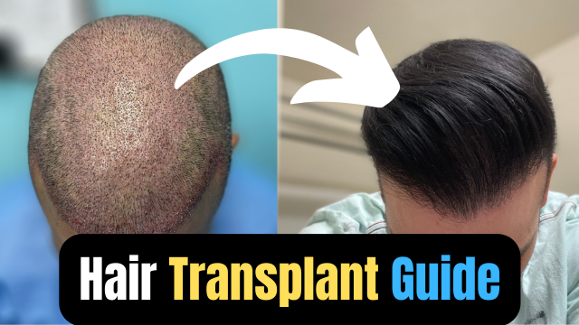 A Guide To Getting A Successful Hair Transplant