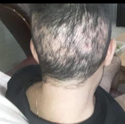 What is FUE Overharvesting?
