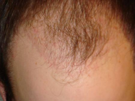 Today a good hair loss remedy can restore your hair