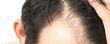 Does Monistat Work For Hair Loss