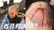Are Hair Transplants Really Painful?