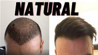 Do Hair Transplants Look Natural?