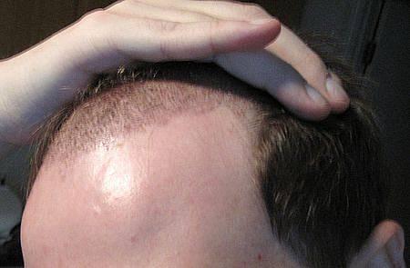 FUE Hair Graft Implantation Methods And Tools