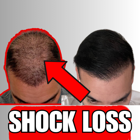 How Long Does Shock Loss Last After A Hair Transplant