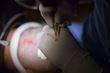 What Is The Success Rate of a Hair Transplant?