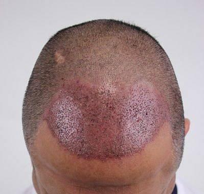 FUE Punches: Sharp Versus Blunt Punches