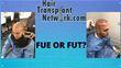 Which Hair Transplant Method Is Best For You?
