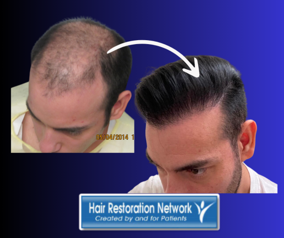The Hair Transplant Network is The Best Online Resource for Hair Transplantation