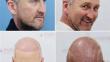 Is Beard Hair Viable For A Hair Transplant