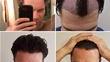 Scott UK Patient Advisor Hair Transplant Journey