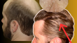 Verteporfin Endless Donor Supply Will Cure Hair Loss