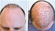 Why Do Some Hair Transplants Fail