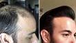 Why I Decided To Have A Hair Transplant