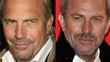 Hair Transplants Are On The Rise and Here's Why