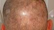 How To Deal with Donor Shock Loss After a Hair Transplant