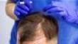 Ultimate Guide To Hair Transplants