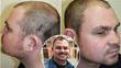 What Is The Best Age To Get A Hair Transplant?
