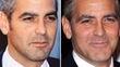 Did George Clooney Have A Hair Transplant?