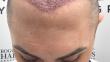 What Questions Should You Ask Before Getting A Hair Transplant