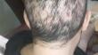 What is FUE Overharvesting?