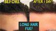 Everything You Need To Know About Long Hair Transplantation