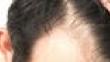 Does Monistat Work For Hair Loss