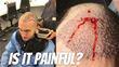 Are Hair Transplants Really Painful?