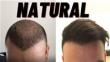 Do Hair Transplants Look Natural?