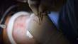 What Is The Success Rate of a Hair Transplant?