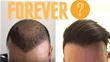 Do Hair Transplants Last Forever?