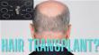 Can You Be Too Bald For A Hair Transplant?