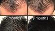 Hair Transplant Timeline