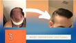 Top 3 Factors To Consider When Researching A Hair Transplant
