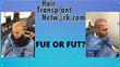Which Hair Transplant Method Is Best For You?