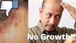 Can Seborrheic Dermatitis Affect Hair Transplant Growth?