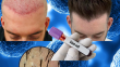 Are Stemcell Hair Transplants Effective?