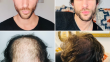 Should You Transplant the Hairline or Crown First?