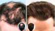 Are You a Good Candidate for a Hair Transplant? 