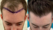 Why You Should Join The Hair Restoration Network